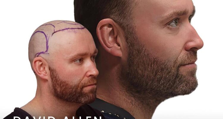 Baerstool's Hair Transplant