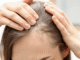 Woman holding hair up to show hairline